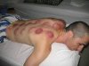 cupping.jpg